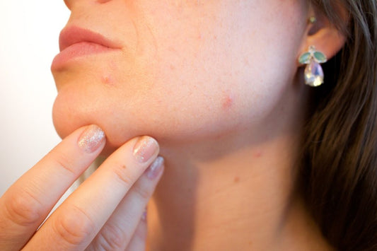 Probiotics and Acne